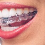 invisalign
