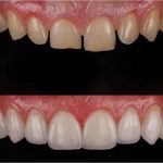 Porcelain_Veneers